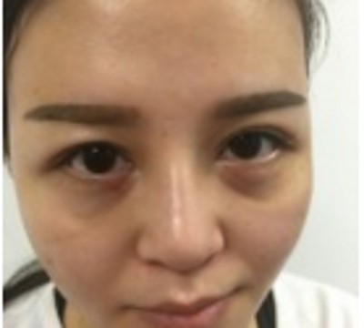 超声波去眼袋,年轻漂亮就这么简单920 超声波去眼袋,年轻漂亮就这么简单920