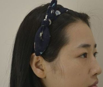 超声波双眼皮案例:为了美我愿意再勇敢一次980 超声波双眼皮案例:为了美我愿意再勇敢一次980