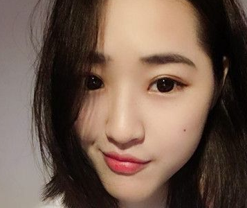 超声波双眼皮案例:为了美我愿意再勇敢一次980 超声波双眼皮案例:为了美我愿意再勇敢一次980