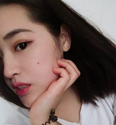 超声波双眼皮案例:为了美我愿意再勇敢一次980 超声波双眼皮案例:为了美我愿意再勇敢一次980