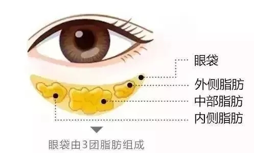 超 声 波去眼袋后眼袋真得不会复发 超 声 波去眼袋后眼袋真得不会复发