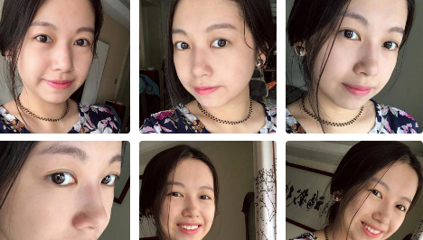 高中就长眼袋,现在用超 声 波去眼袋消除le 高中就长眼袋,现在用超 声 波去眼袋消除le