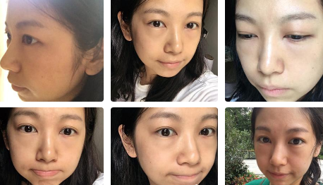 高中就长眼袋,现在用超 声 波去眼袋消除le 高中就长眼袋,现在用超 声 波去眼袋消除le