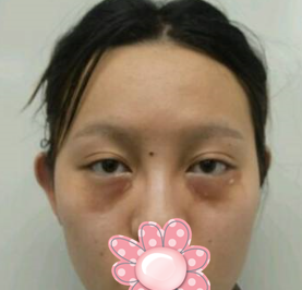 遗传性眼袋消除方法——超声波去眼袋196 遗传性眼袋消除方法——超声波去眼袋196