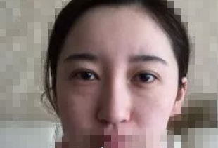 超 声 波去眼袋后充满le青春和阳光气息 超 声 波去眼袋后充满le青春和阳光气息