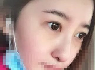超 声 波去眼袋后充满le青春和阳光气息 超 声 波去眼袋后充满le青春和阳光气息