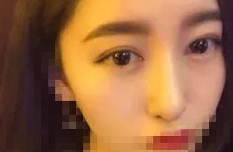 超 声 波去眼袋后充满le青春和阳光气息 超 声 波去眼袋后充满le青春和阳光气息