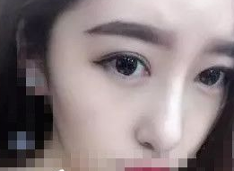 超 声 波去眼袋后充满le青春和阳光气息 超 声 波去眼袋后充满le青春和阳光气息