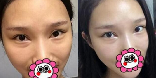 超 声 波去眼袋恢复全过程,详细记录 超 声 波去眼袋恢复全过程,详细记录