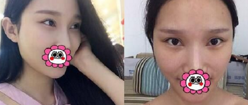 超 声 波去眼袋恢复全过程,详细记录 超 声 波去眼袋恢复全过程,详细记录
