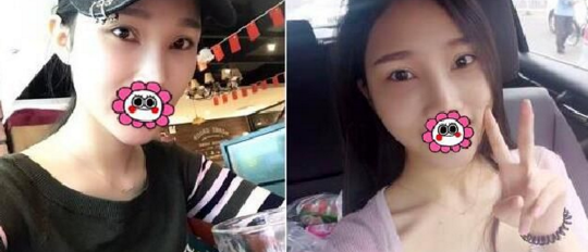 超 声 波去眼袋恢复全过程,详细记录 超 声 波去眼袋恢复全过程,详细记录