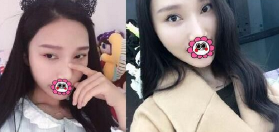 超 声 波去眼袋恢复全过程,详细记录 超 声 波去眼袋恢复全过程,详细记录