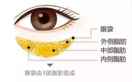 超声波去眼袋手术做遗传性眼袋为什么不反弹?330 超声波去眼袋手术做遗传性眼袋为什么不反弹?330