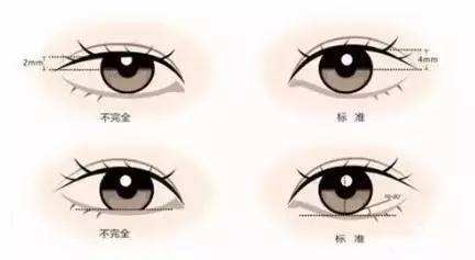 双眼皮手术失败修复哪家强?327 双眼皮手术失败修复哪家强?327