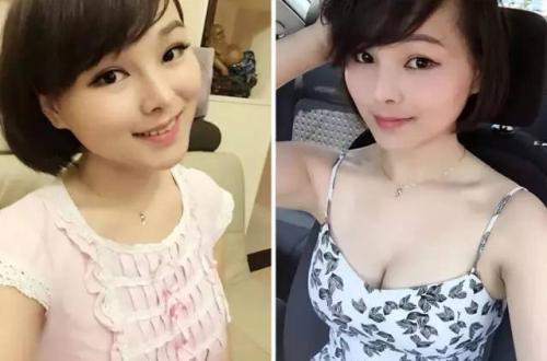 宝妈的丰胸成果,超声波自体脂肪丰胸手术204 宝妈的丰胸成果,超声波自体脂肪丰胸手术204