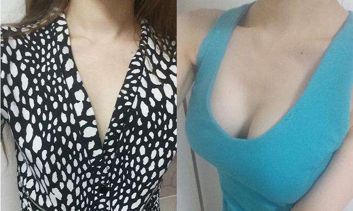 超 声 波自体脂肪丰胸效果更好 超 声 波自体脂肪丰胸效果更好