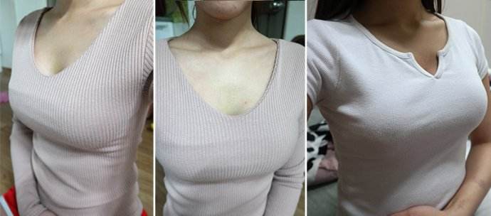 超 声 波自体脂肪丰胸效果更好 超 声 波自体脂肪丰胸效果更好