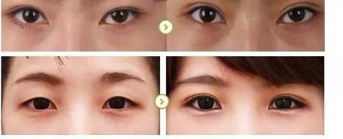 双眼 皮手术后会发炎吗? 双眼 皮手术后会发炎吗?