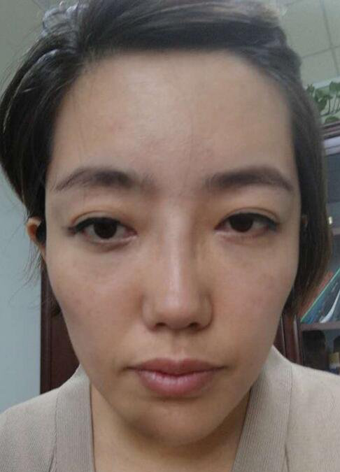 快来看超声波去眼袋是如何治愈我的三观618 快来看超声波去眼袋是如何治愈我的三观618