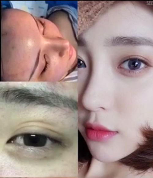 双眼 皮手术后会发炎吗? 双眼 皮手术后会发炎吗?