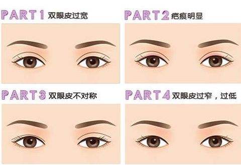 双眼 皮手术后会发炎吗? 双眼 皮手术后会发炎吗?