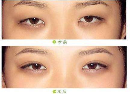 双眼 皮手术后会发炎吗? 双眼 皮手术后会发炎吗?