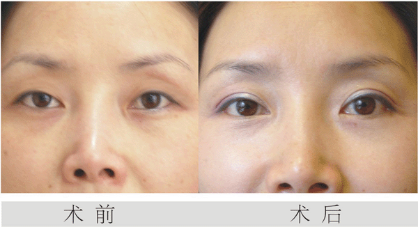 双眼 皮手术后会发炎吗? 双眼 皮手术后会发炎吗?