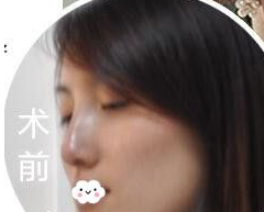 在重庆超雅做了鼻综合后我又来体验超声波自体脂肪丰胸260