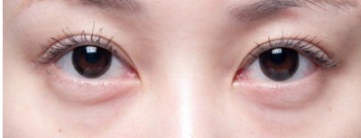 超声波去眼袋,完美解决眼袋困扰174 超声波去眼袋,完美解决眼袋困扰174