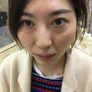 超声波去眼袋,好到不意外817 超声波去眼袋,好到不意外817