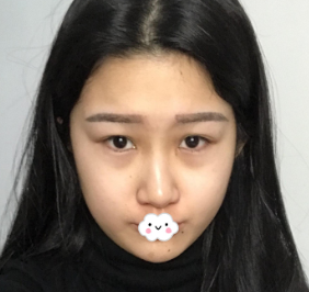 超声 波瘦脸