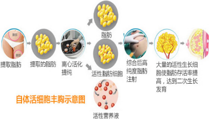 简单说下我为什么用超声波自体脂肪丰胸吧!908 简单说下我为什么用超声波自体脂肪丰胸吧!908