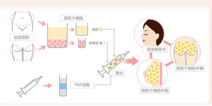 超声波自体脂肪丰胸手术具备何种优势呢?462 超声波自体脂肪丰胸手术具备何种优势呢?462