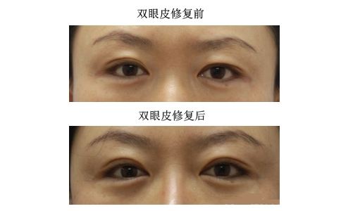 超声波双眼皮是如何做到私人定制美眼的?159 超声波双眼皮是如何做到私人定制美眼的?159