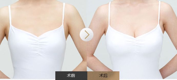 超声波自体脂肪丰胸打造出来的胸真实感如何?042 超声波自体脂肪丰胸打造出来的胸真实感如何?042