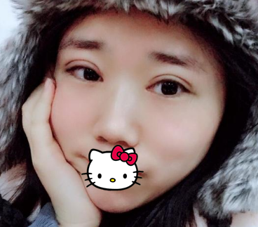 好奇超 声 波双眼 皮效果如何得,来看看wǒ做得 好奇超 声 波双眼 皮效果如何得,来看看wǒ做得
