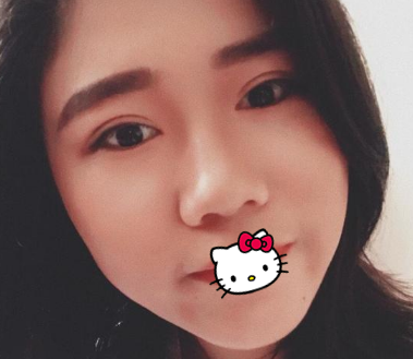 好奇超 声 波双眼 皮效果如何得,来看看wǒ做得 好奇超 声 波双眼 皮效果如何得,来看看wǒ做得