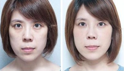 超 声 波去眼袋与内切去眼袋相比哪种更无痕呢? 超 声 波去眼袋与内切去眼袋相比哪种更无痕呢?