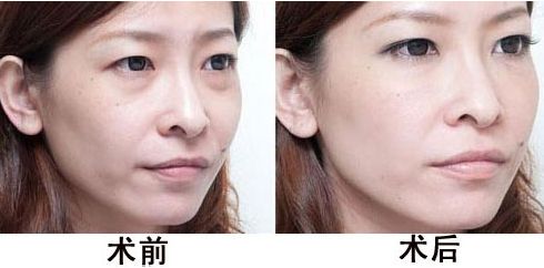 超 声 波去眼袋与内切去眼袋相比哪种更无痕呢? 超 声 波去眼袋与内切去眼袋相比哪种更无痕呢?