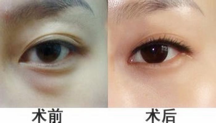国庆去哪里嗨皮？wǒ去重庆超雅做超 声 波去眼袋啦~