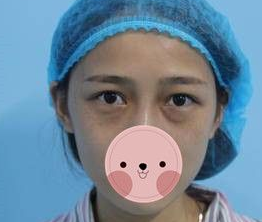 国庆去哪里嗨皮？wǒ去重庆超雅做超 声 波去眼袋啦~