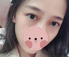 国庆去哪里嗨皮？wǒ去重庆超雅做超 声 波去眼袋啦~