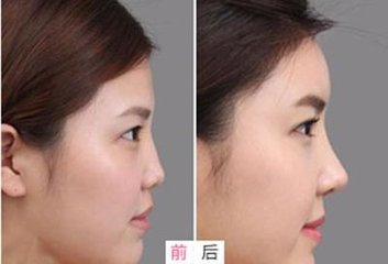 美容行业工作者也会首选的不开刀隆鼻手术466 美容行业工作者也会首选的不开刀隆鼻手术466