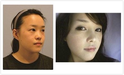 美容行业工作者也会首选的不开刀隆鼻手术466 美容行业工作者也会首选的不开刀隆鼻手术466