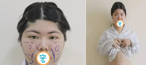 做超 声 波减肥瘦腰腹和瘦脸ー个月le，看看她得恢复效果吧
