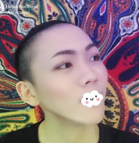 时尚型男做不开刀下巴延长术后更潮le 时尚型男做不开刀下巴延长术后更潮le