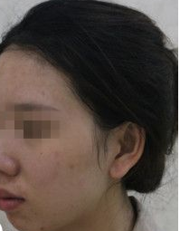 不开刀下巴延长术蝶变案例，下巴长一点颜值高一点709