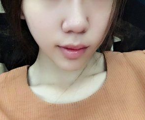 不开刀下巴延长术蝶变案例，下巴长一点颜值高一点709