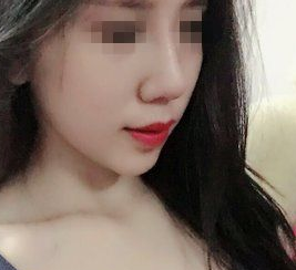 不开刀下巴延长术蝶变案例，下巴长一点颜值高一点709