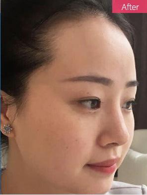 重庆超雅不开刀隆鼻有什么特色?103 重庆超雅不开刀隆鼻有什么特色?103